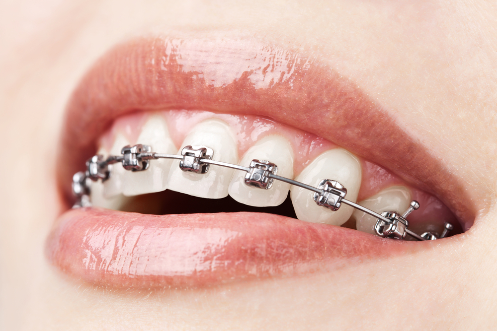 fixed dental appliances